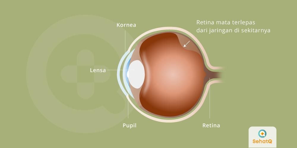 Ablasi retina sehatq penyakit
